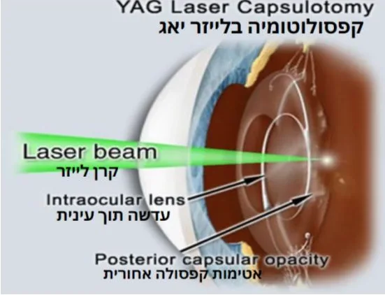 תרשים קטרקט משני
